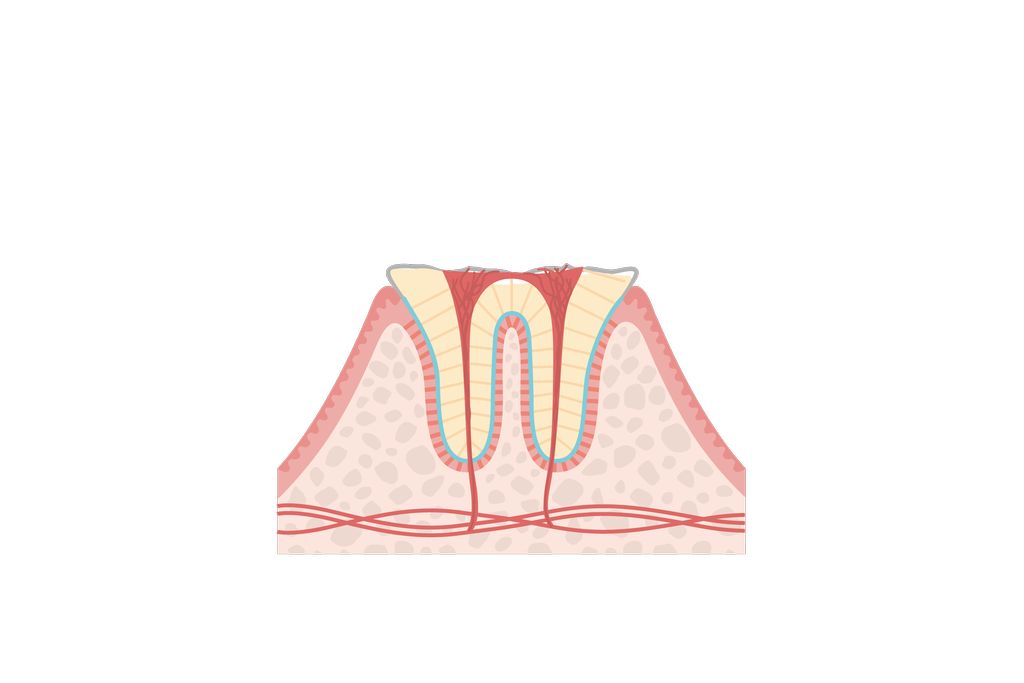 C4（歯根・保存不可）